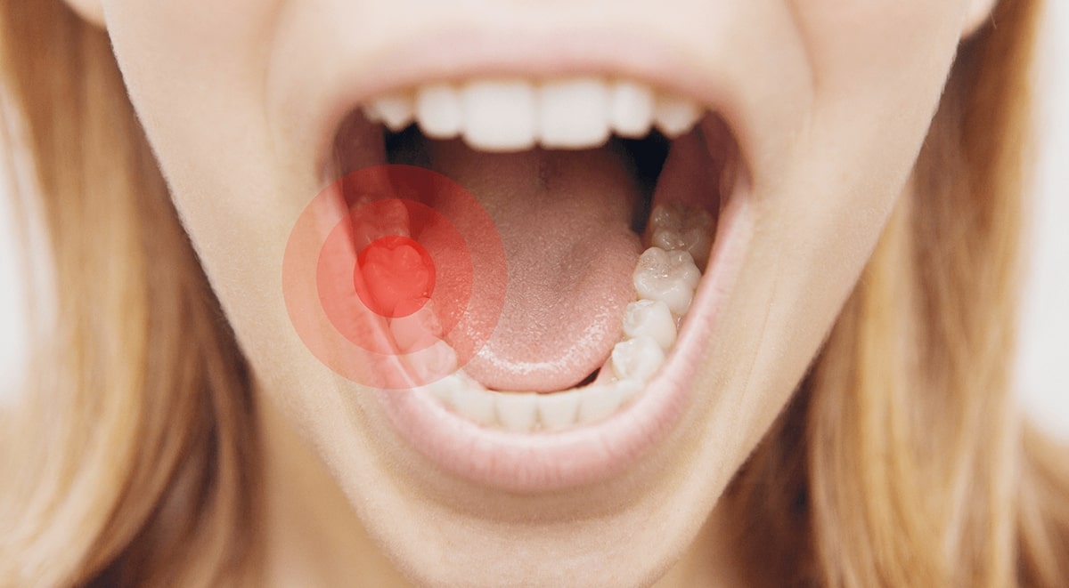 iltihaplı diş neden ağrır, apseli diş çekilir mi